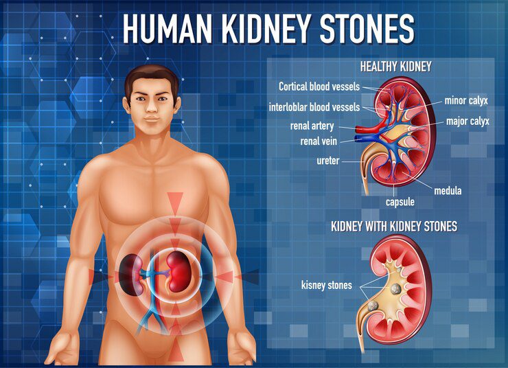 Kidney Stones Illustration Iih